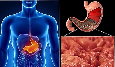 Simptome și tratament pentru gastrită atrofică cronică