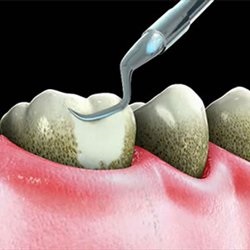 Tratamentul bolii gingiilor, tratamentul bolii gingivale la Moscova