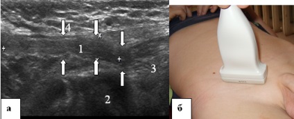 4 Criterii de ultrasunete pentru diagnosticarea și evaluarea tratamentului bolilor chirurgicale de inghinale și scrot