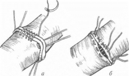 Anastomoza vasculară - chirurgie vasculară