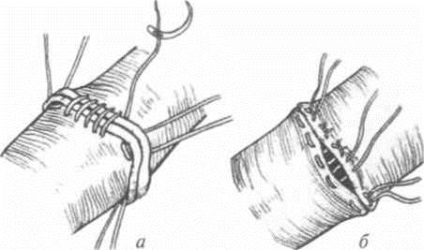 Vascularis anastomosis - érrendszeri sebészet