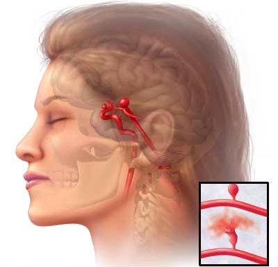 Anevrismul cauzat de creier, simptome, tratament