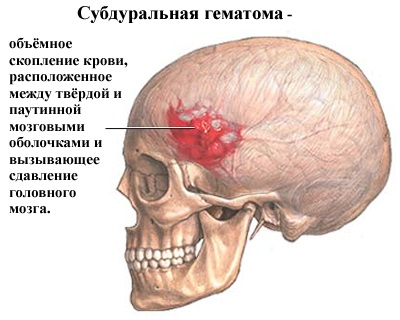 Anevrismul cauzat de creier, simptome, tratament