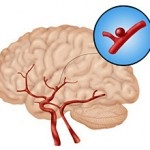 Anevrismul semnelor vaselor cerebrale, tratamentul