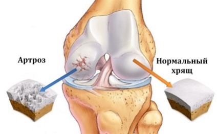Артроз колінного суглоба симптоми і лікування його різними методами