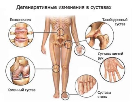 Osteoartrita simptomelor articulației genunchiului și tratamentul cu diverse metode