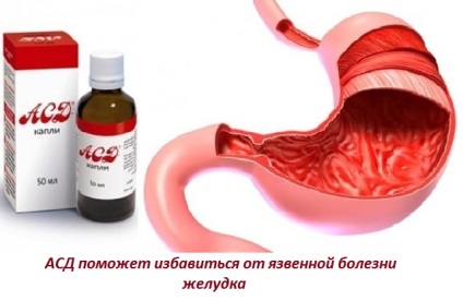 Asd 2 cu aplicație ulcer gastric pentru o persoană, instrucțiuni despre cum să bea corect