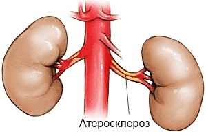 Ateroscleroza arterei renale