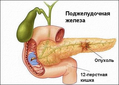 Boli ale pancreasului, simptome, tratament, prevenire