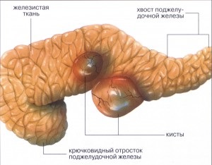 Boli ale pancreasului, simptome, tratament, prevenire