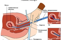 Durerea în miomul uterului