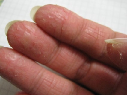 Mai degrabă pentru a trata dacă există și nu vindecă fisuri pe degetele degetelor simptome ale motivului și tratamentului