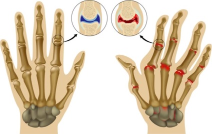 Ce trebuie făcut dacă articulațiile degetelor unei dureri de mână și tratament