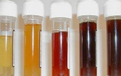 Culoarea urinei este o măsură a sănătății dvs., medicamentul are legătură cu sănătatea și medicina