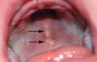 Diagnosticul și tratamentul leziunilor orale la nou - născuți - stomatologie pediatrică - știri și