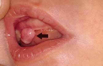 Diagnosticul și tratamentul leziunilor orale la nou - născuți - stomatologie pediatrică - știri și