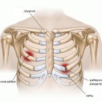 Diagnosticul, simptomele și tratamentul coastelor contuzate