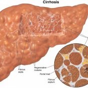 Dieta și nutriția cu ciroză hepatică cu ascite
