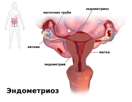 Endometriózis esetén