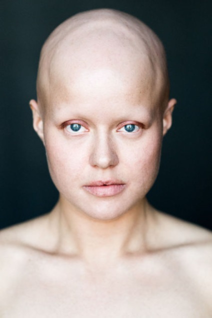 În jos cu canoanele și stereotipurile, șapte portrete magnifice ale fetelor care suferă de alopecie