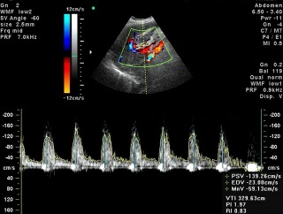 Dopplerografie (uzdg) fluxul sanguin utero-placentar - prețuri, rate, decodificare, pregătire,