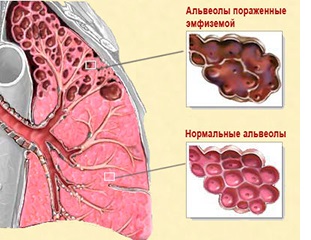 Emfizemul plămânilor este o modalitate unică de tratare a oxigenului