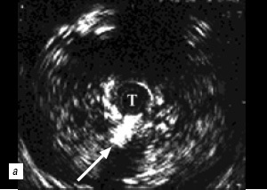 A felső húgyvezeték és a húgycső endoluminalis ultrahangvizsgálata