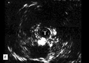 A felső húgyvezeték és a húgycső endoluminalis ultrahangvizsgálata