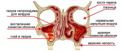 Sinusitis kezelés folk orvosokkal otthon