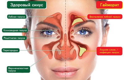 Sinusitis kezelés folk orvosokkal otthon