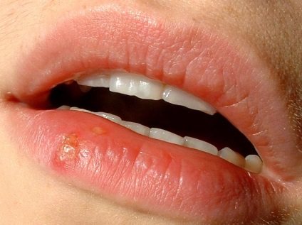 Herpesz az ajkakon - kezelés