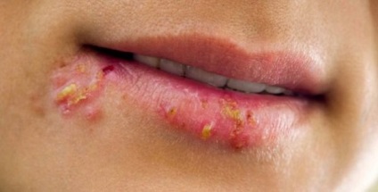 Herpesz az ajkakon, kezelés, hatások és fotók