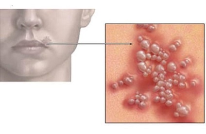 Herpesul provoacă buzele, tratamentul, efectele și fotografiile