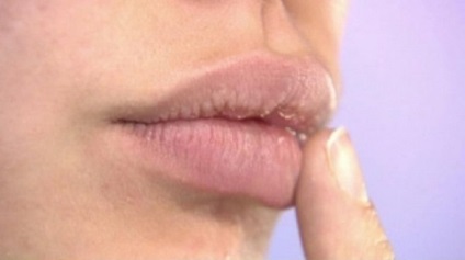 Herpesul provoacă buzele, tratamentul, efectele și fotografiile
