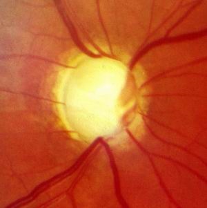 clinici Eye in Germania - tratamentul glaucomului și a altor boli de ochi în Germania - medhaus, Germania