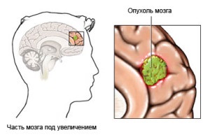 Az agyi kezelés glioma és a teljes gyógyulás prognózisa