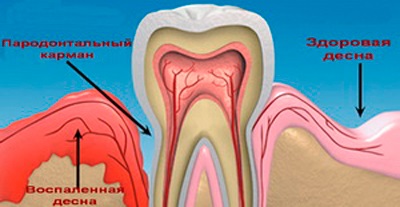 Pungi gingivale profunde