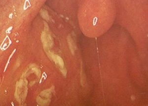 Csontos tonsillitis tünetei, otthoni kezelés (fotó)