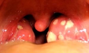 Csontos tonsillitis tünetei, otthoni kezelés (fotó)