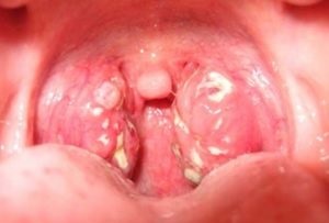 Csontos tonsillitis tünetei, otthoni kezelés (fotó)