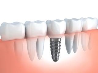 Implanturi în stomatologie din Israel (implantarea dinților), prețuri, israhospital
