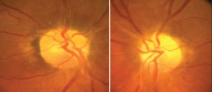 Bolile ischemice ale retinei și ale nervului optic - cât de periculoase, cum să tratăm
