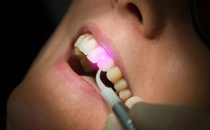 Cum sa scapi de functiile dentare de curatare a placii dentare in stomatologie