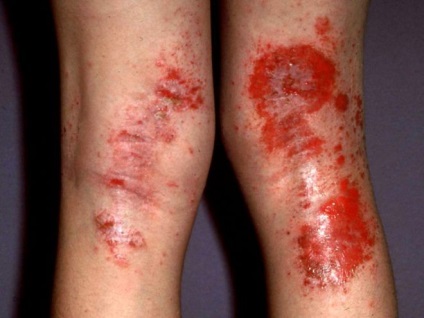 Cum să tratați eczema pe picioare la domiciliu
