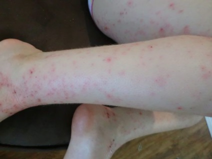 Cum să tratați eczema pe picioare la domiciliu