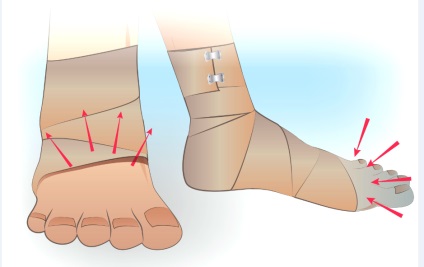Hogyan kell kezelni a hematómát a lábszáron lévő kopaszodás után?