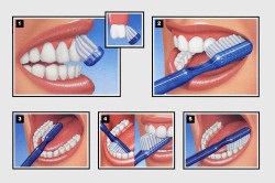A fogszuvasodás megállítása
