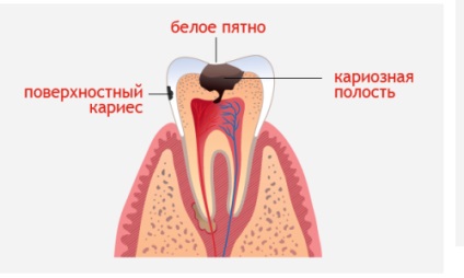 A fogszuvasodás megállítása
