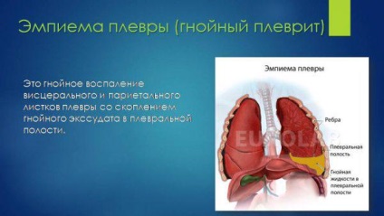 Як розпізнати пневмонію у дорослого і дитини з температурою і без, з кашлем і без, перші