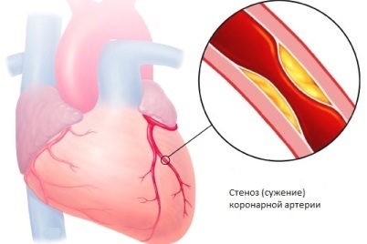 Cum se recunoaște angina prin simptome, care este natura durerii în angină pectorală